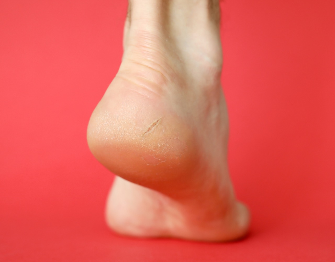 腳跟/足部龜裂