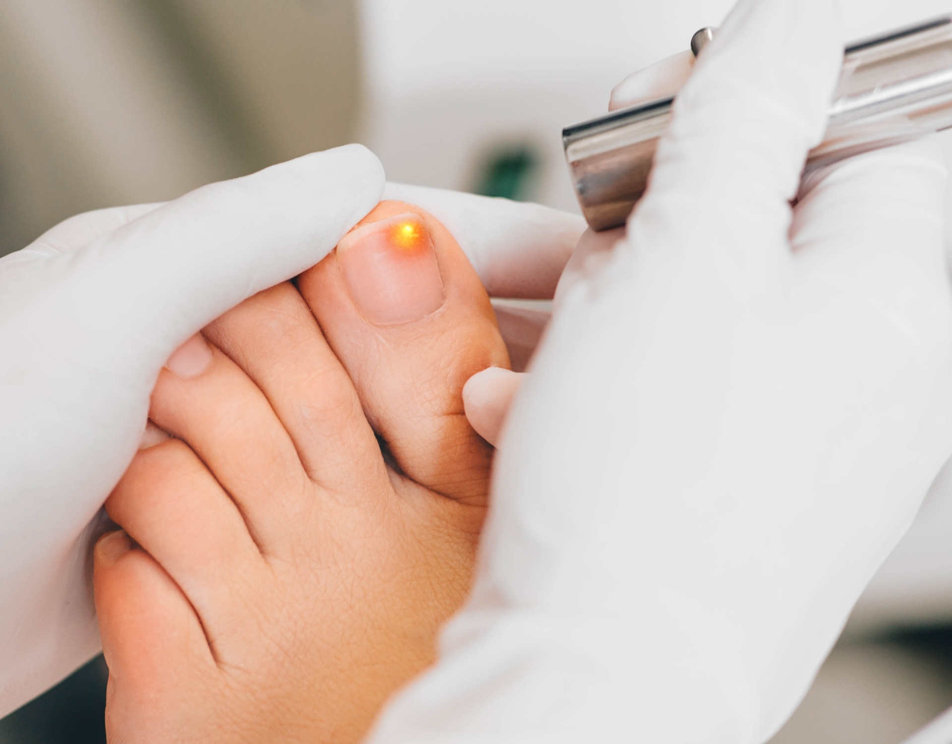 灰甲修剪及治療