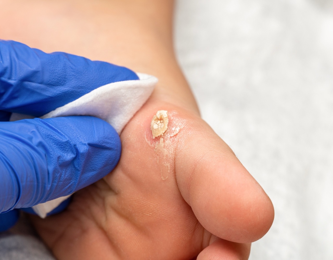 雞眼專治免手術